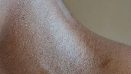 Prediabetes Warning: 5 Subtle Physical Signs Your Blood Sugar is Starting to Spike